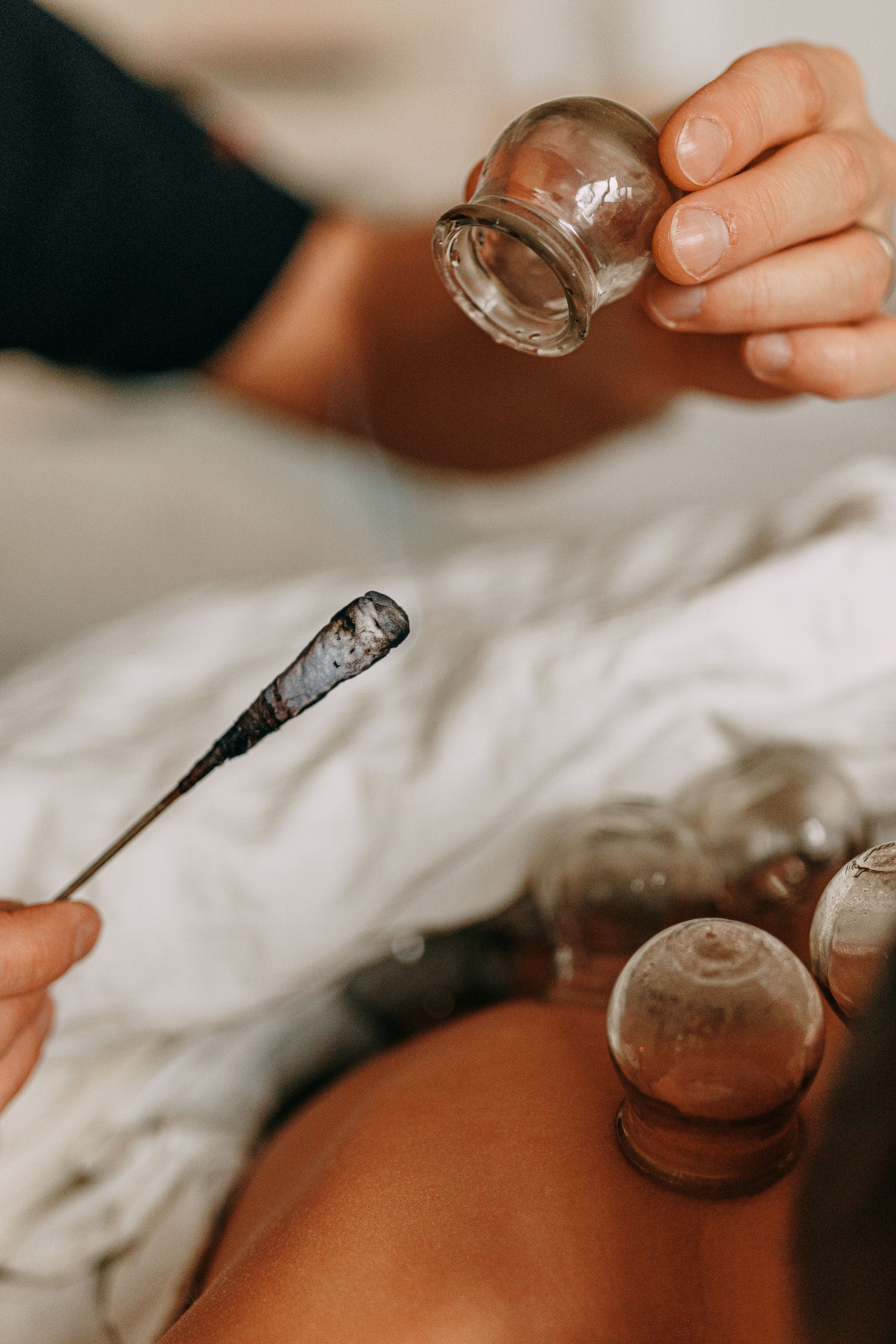 Fire Cupping. Fire cupping cups on back of young boy